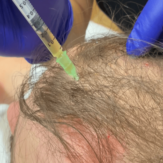 Prp Hair Rejuvenation