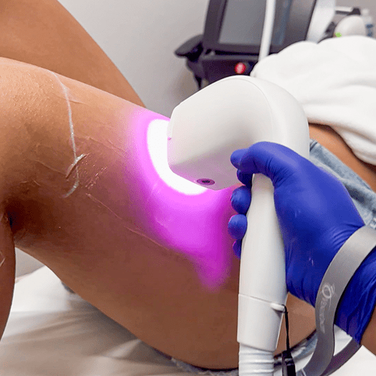 Laser Hair Removal