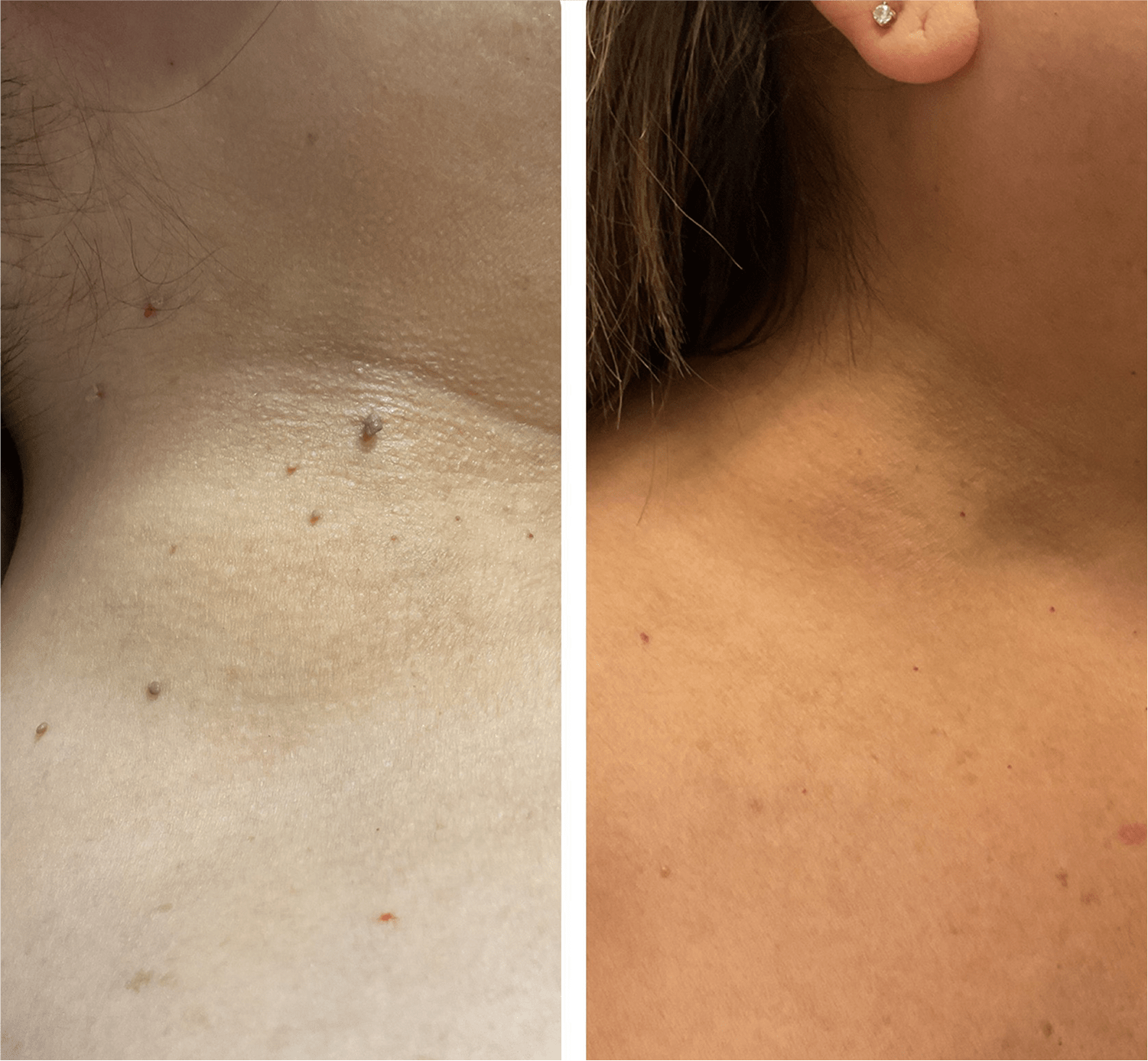 Skin Tag Removal