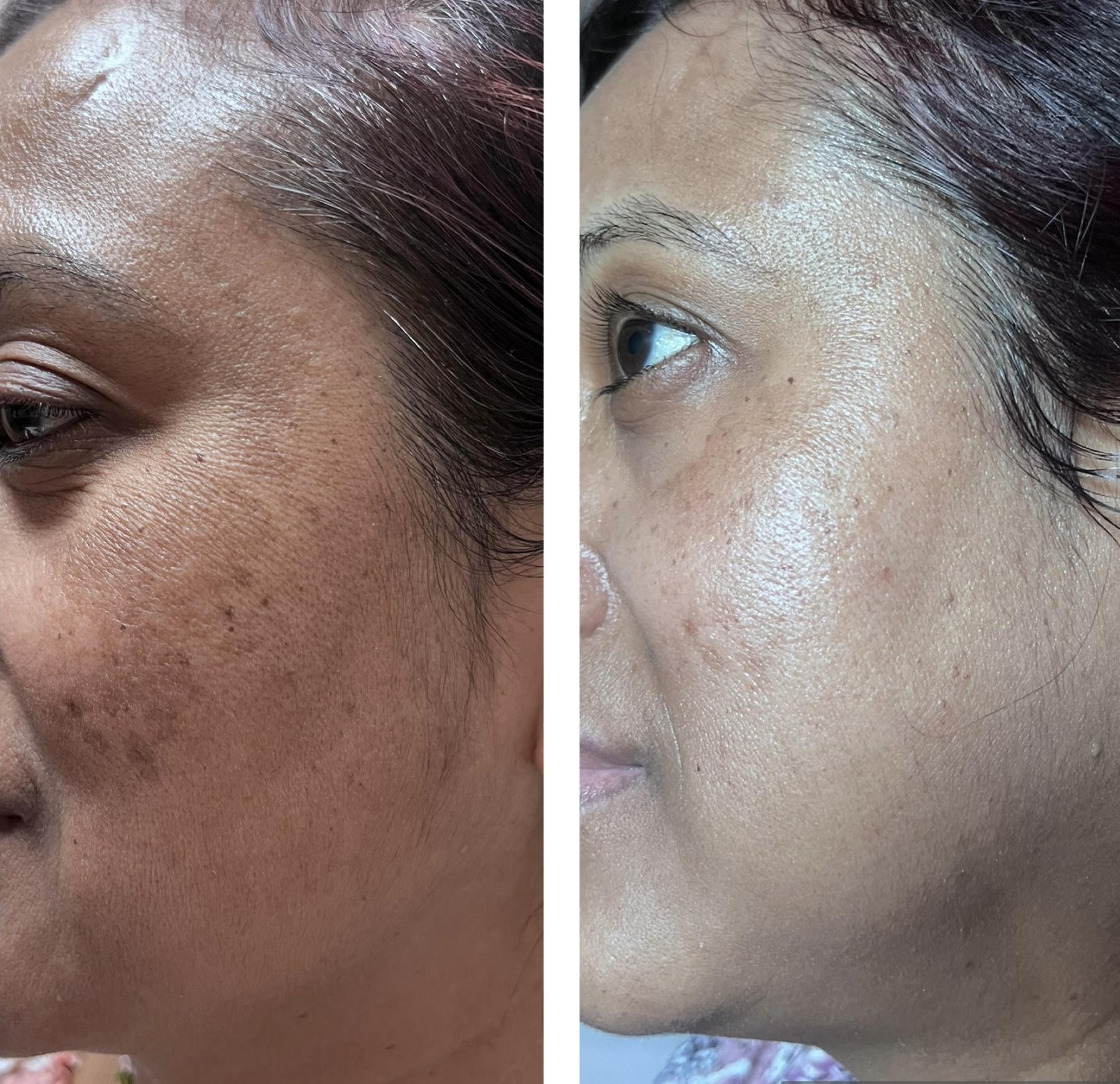 Melasma Treatment