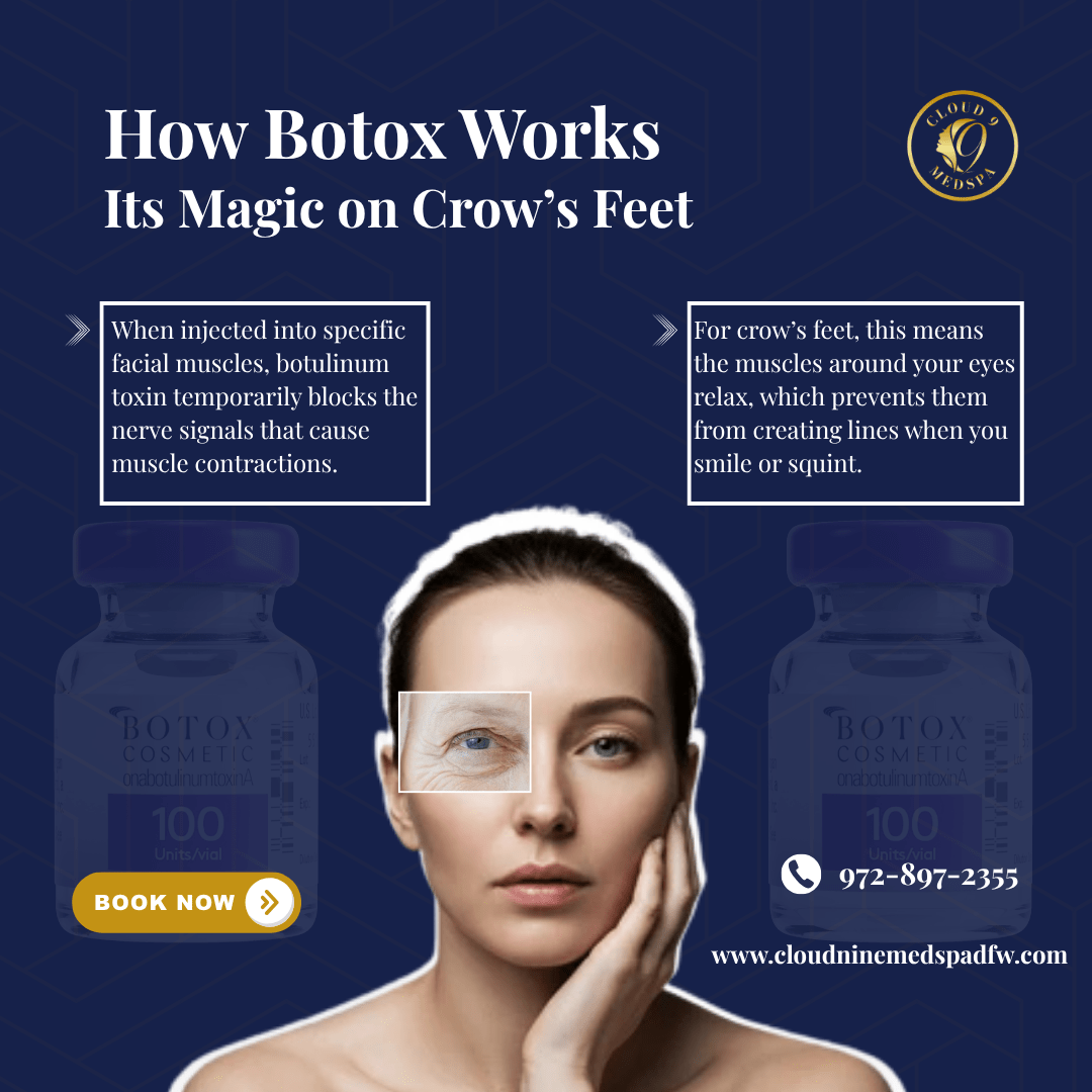 How Botox Works Its Magic on Crow's Feet