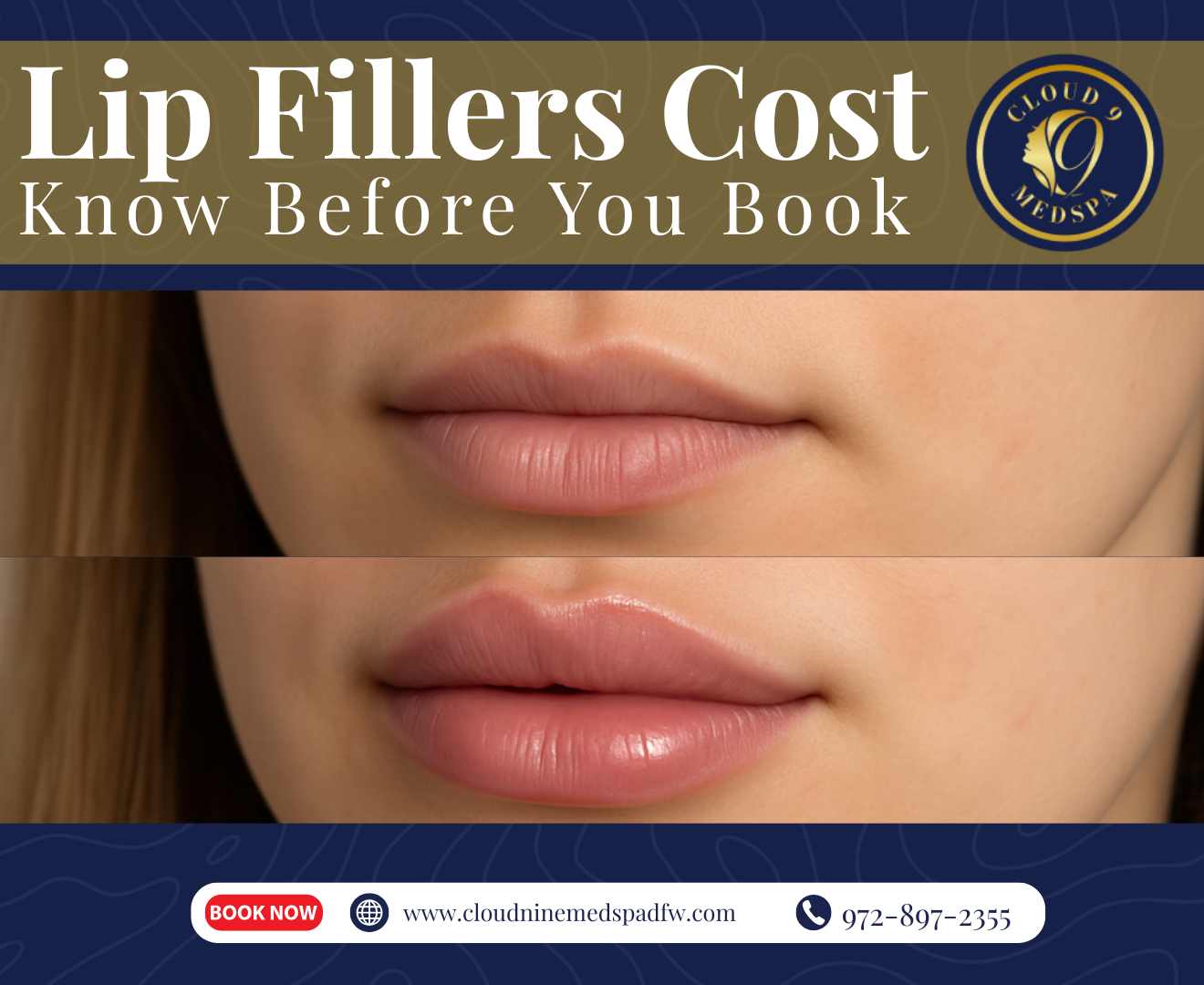 Lip Fillers Cost | Know Before You Book
